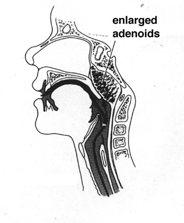 Black and white illustration of enlarged adenoids