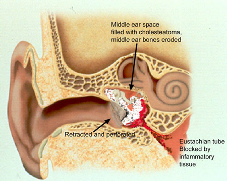 Colorful illustration of cholesteatoma and erosion of the middle ear