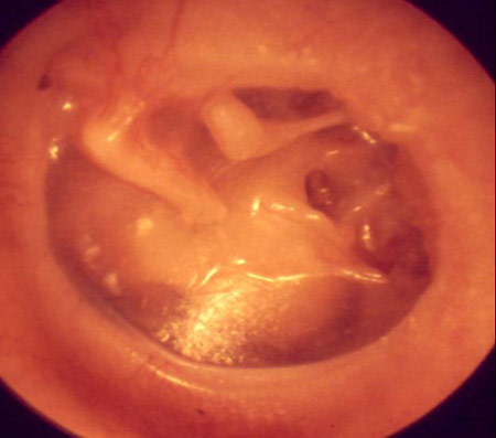 close up photo of a retracted ear drum