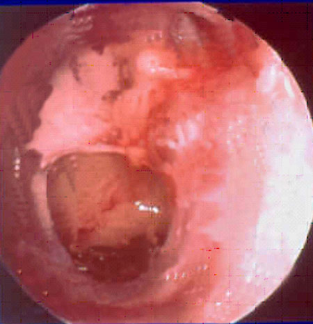 Close up photo of a perforated ear drum
