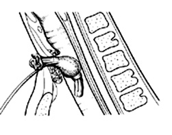 An illustration of a tracheotomy