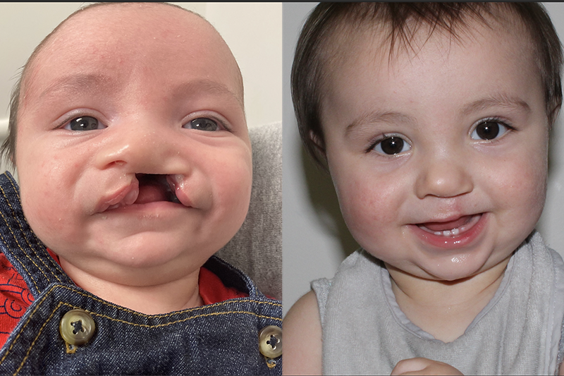Left image shows Liam's cleft palate_Right image shows repair without any significant deformation.