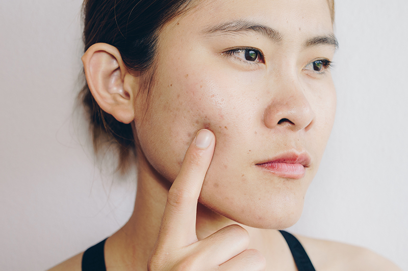 woman with acne scarring