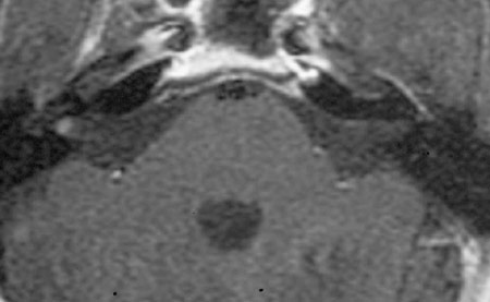 Image of Vestibular Schwannoma