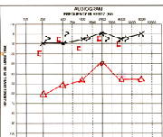 Graph of hearing test