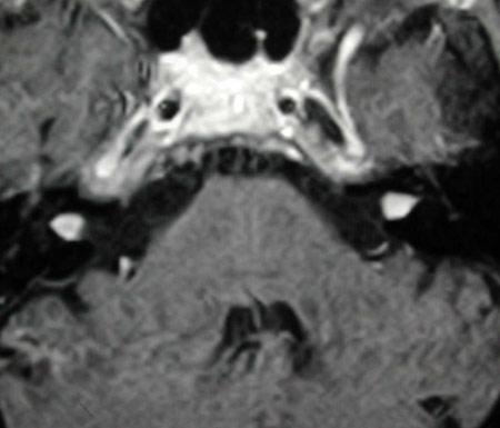 Image of Bilateral vestibular schwannoma