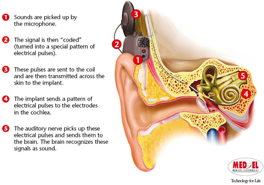 A colorful illustration of the inner ear and how the cochlear implant connects