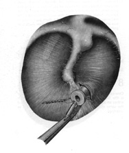 Black and white illustration of an ear tube inserted into the ear drum