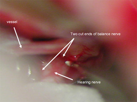 Close-up photo of nerve surgery