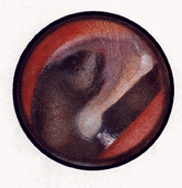Close up photo of a normal eardrum