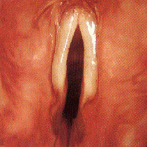 A close up image of vocal cords.
