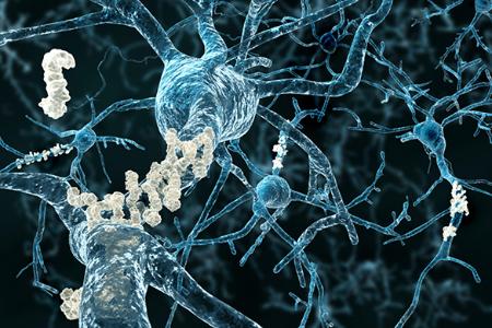 Alzheimer's disease neurons with amyloid plaques