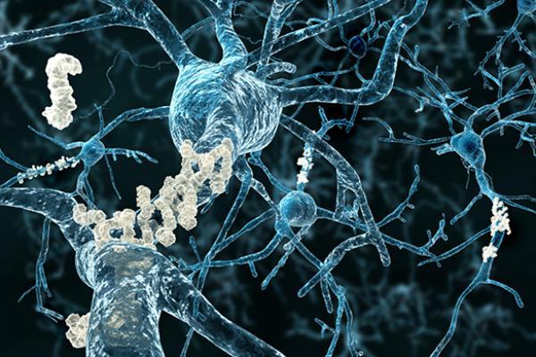 Alzheimer's disease neurons with amyloid plaques