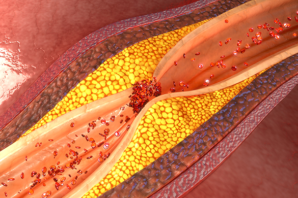 A lifelike illustration of a red artery blocked with yellow plaque as red blood cells get trapped at the blockage.