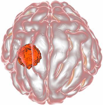 Pink and white illustration of a walnut-size brain tumor