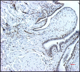Slide of increased stain (brown) of histone H4K16Ac in lung tissues from an IPF patient