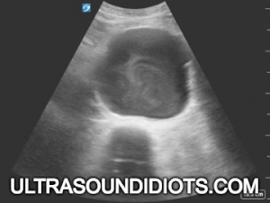 Image of ultrasound with Ultrasoundidiots.com across bottom