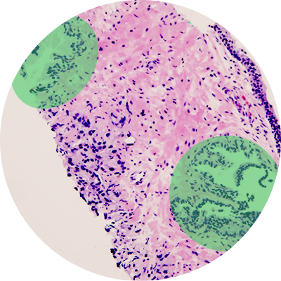Healthy parts of biopsy highlighted