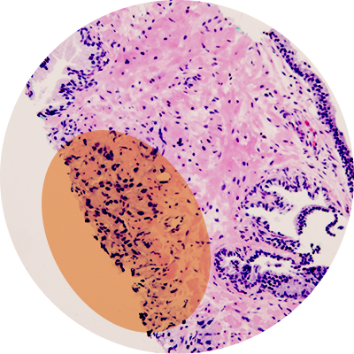 Cancerous parts of biopsy highlighted