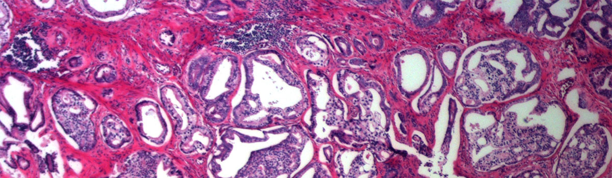 Microscopic image of biopsy