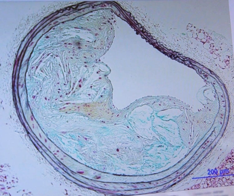 Atherosclerosis slide