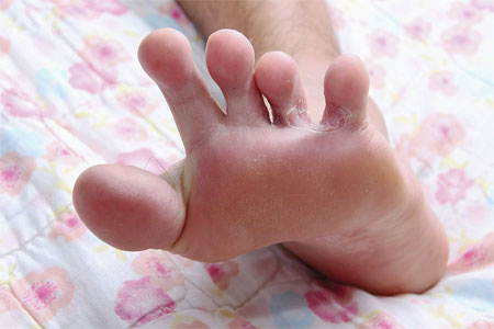 Foot with psoriasis