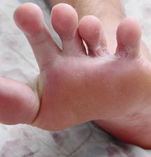 Foot with psoriasis